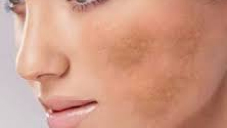 How to Banish Melasma and Restore Your Skin's Natural Tone?