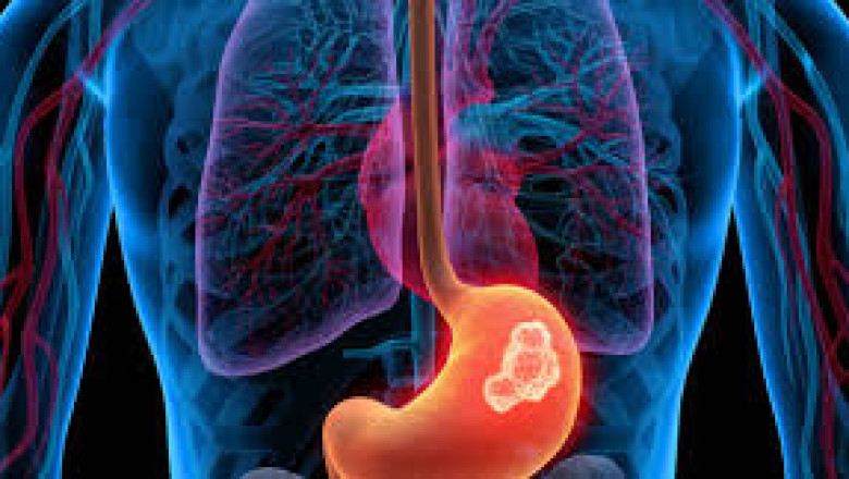 The Role of Gastroscopy in Diagnosing Gastric Cancer