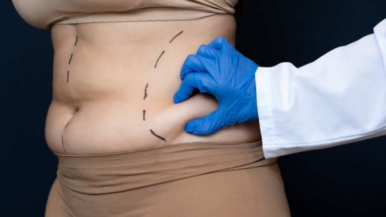 Liposuction That Helps You Take the First Step Toward Change