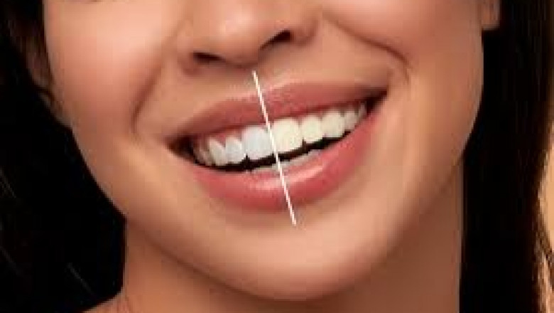 Transform Your Smile with Laser Teeth Whitening in Islamabad