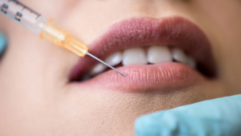 Level Up Your Look with Lip Filler Confidence