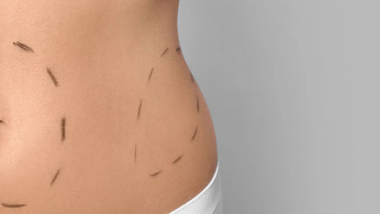 Tummy Tuck Surgery at Dr. Monisha Kapoor Aesthetics: Sculpting Confidence with Precision