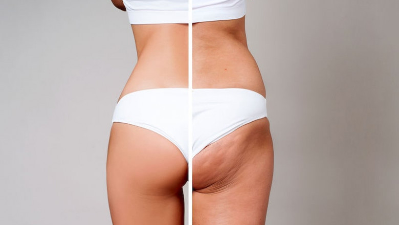 Smooth Skin Starts Now, Best Anti-Cellulite Solutions