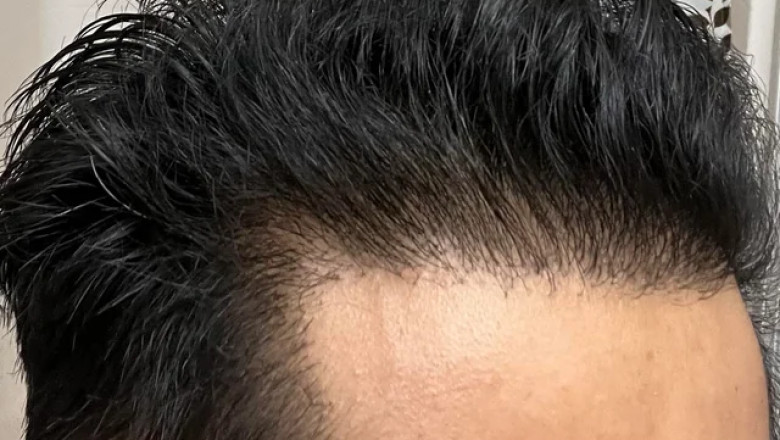 FUE vs DHI: Which Costs More for 3,000 Grafts in Dubai UAE