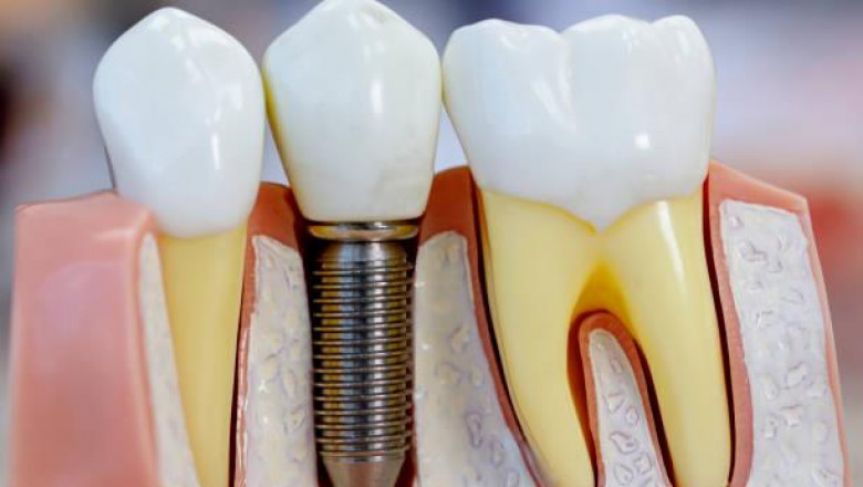 Unlock Your Smile: Top Benefits of Getting a Dental Implant in Osseo