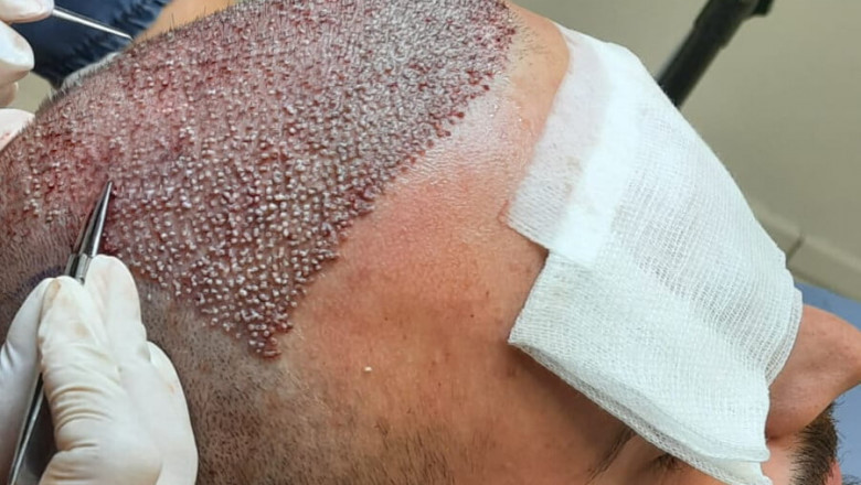 FUE Hair Transplant, The Natural Choice for Hair Restoration