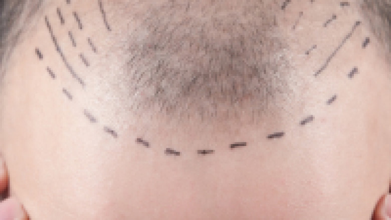 Hair Transplant in Gurgaon, Lucknow & Noida – Natural Results with Expert Care by Dr. Amit Gupta