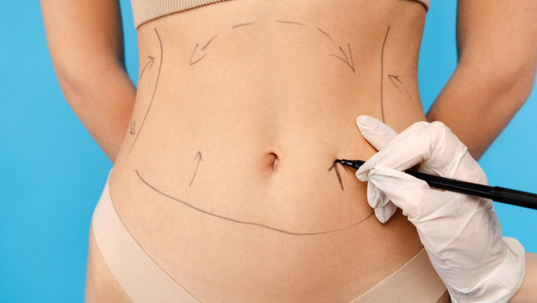 Liposuction for Defined Curves and Toned Body Contours