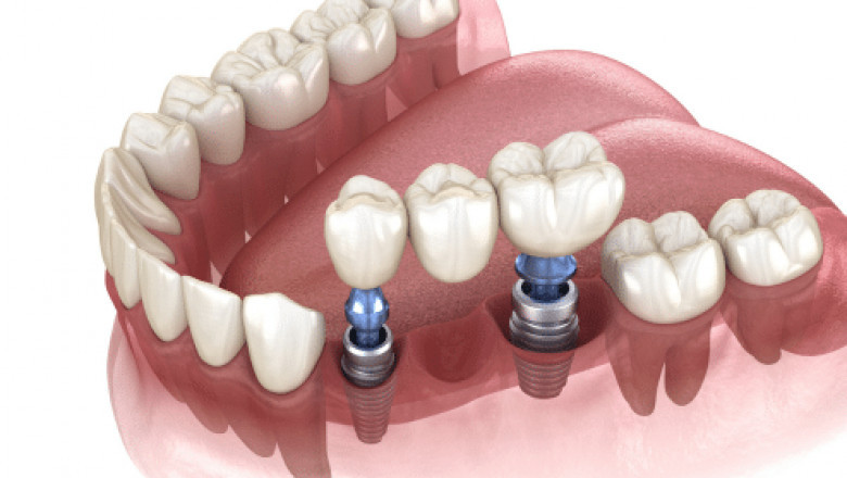 Raising Low Sinuses for Successful Dental Implant Placement