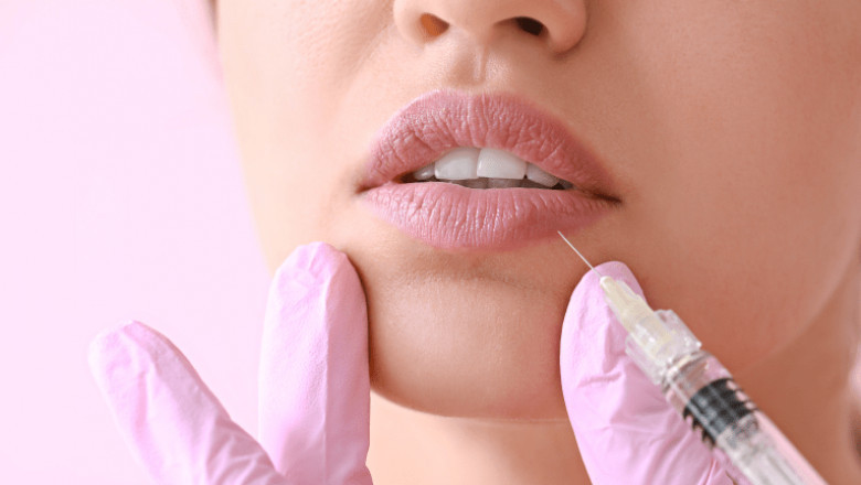 How to Make Lip Fillers Last Longer: Pro Advice for Lasting Volume