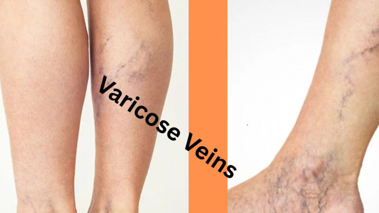 How to Determine If Your Varicose Veins Are Genetic?