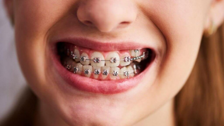 10 Things to Know Before Getting Braces in Dubai