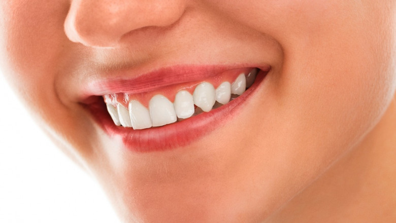 Teeth Whitening Tips to Brighten Your Smile Without Sensitivity