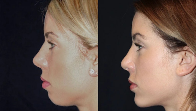Best Aesthetic Clinics in dubai for Chin Fillers: The Ultimate Non-Surgical Chin Augmentation