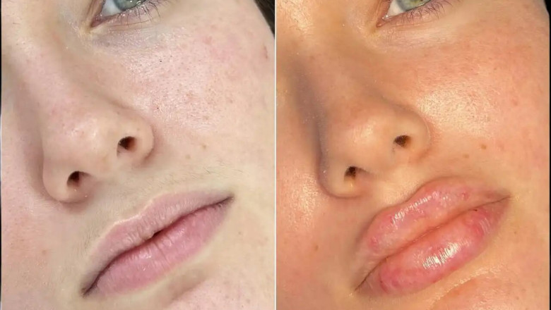 Best Aesthetic Clinics in dubai for Fillers: Top Doctors to Consult
