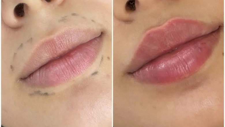 Long-Lasting Effects of Juvederm in Dubai Treatments