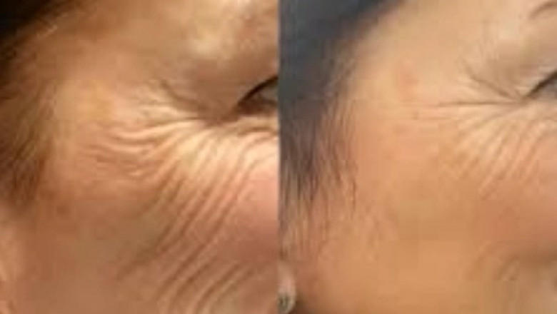 Push Skin Goals with Profhilo in Dubai