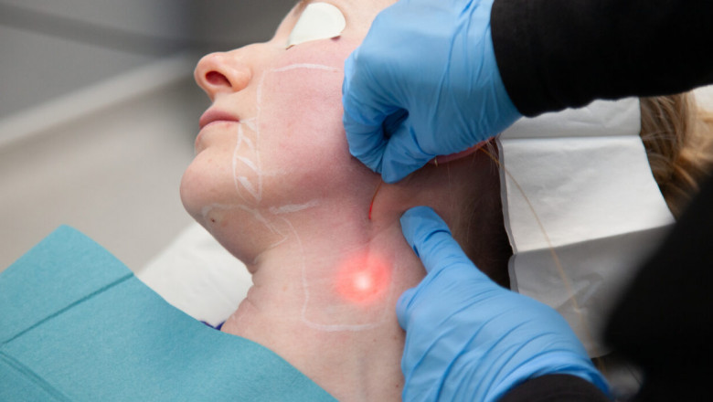 Endolift for Midface Lift
