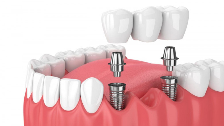 Is Full Mouth Dental Implants Cost Worth the Life-Changing Relief