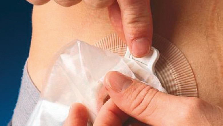 OstomyStoma Care Market Poised for Growth as Global Awareness and Healthcare Investments Increase