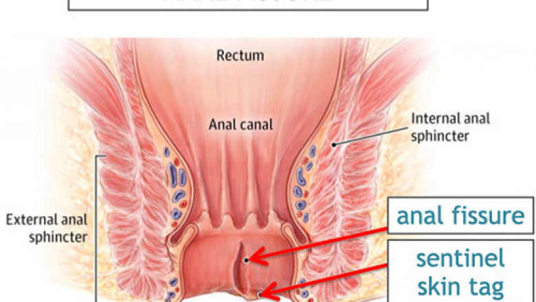 Top Fissure Treatment in Bangalore: Dr. Bhushan Chittawadagi’s Expertise at Your Service