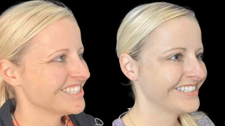 Trusted by Many Best Plastic Surgeons in Dubai for Botox