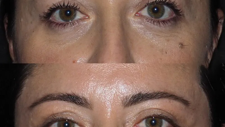 How Eye bag removal in Dubai Can Make You Look Younger
