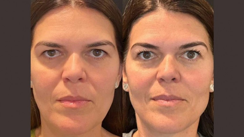 Thread Lift for a Youthful Neck: Why the Best Plastic Surgeon in Dubai Recommend It