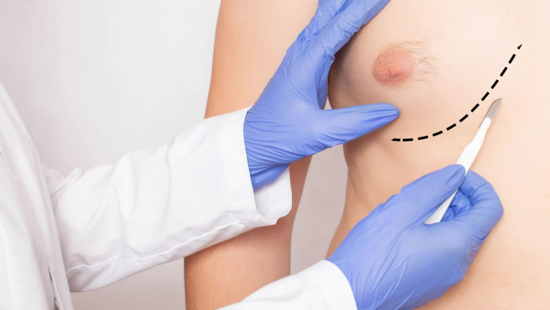 When Is Gynecomastia Surgery Necessary?