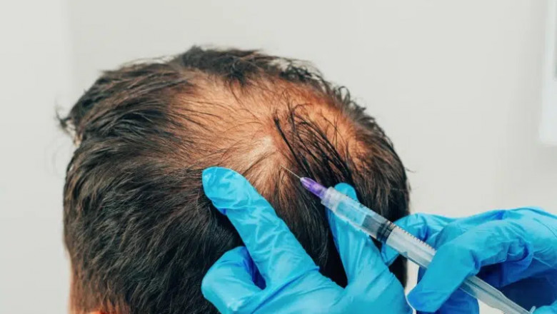 Who Is An Ideal Candidate For Prp Therapy?