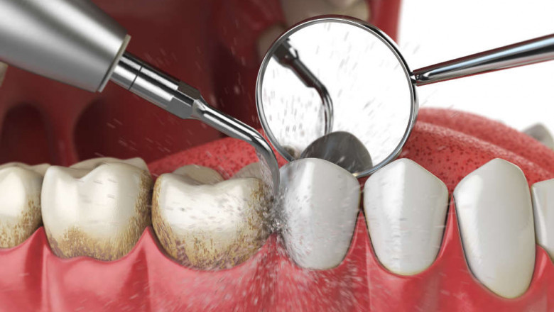 What to Expect During a Deep Cleaning Appointment