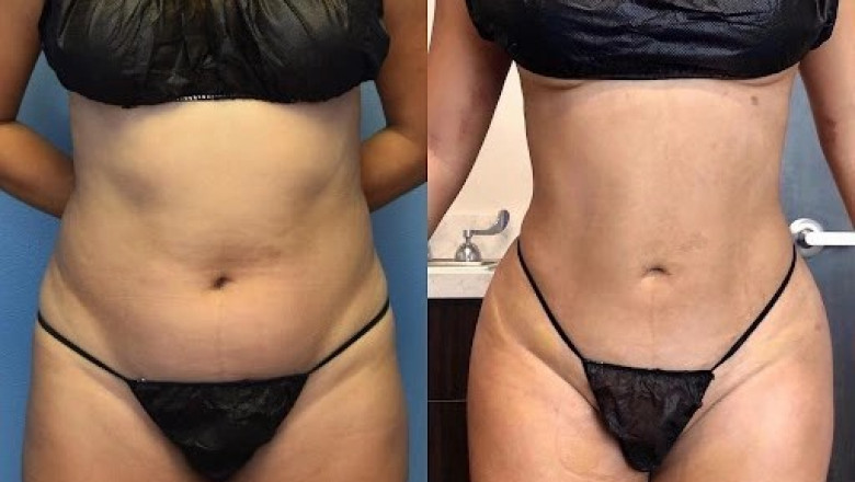 Addressing the Unseen Challenges of Liposuction in Dubai