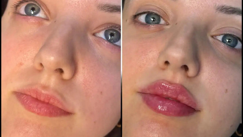 Fillers Treatment in Dubai: Your Path to Perfect Facial Contours