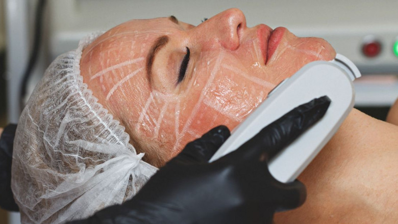 HIFU for Décolletage: Smooth and Firm Chest Skin
