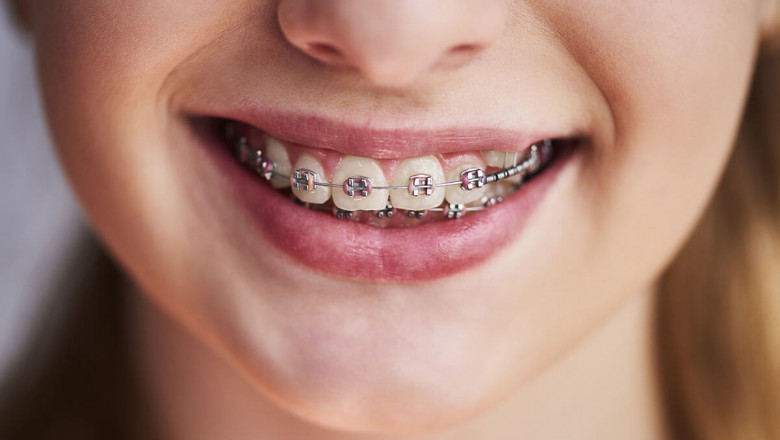 How to Save on Dental Braces Cost Without Sacrificing Quality