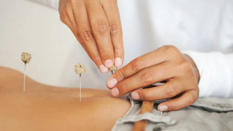 Is Acupuncture the Missing Piece in Your Fertility Journey?
