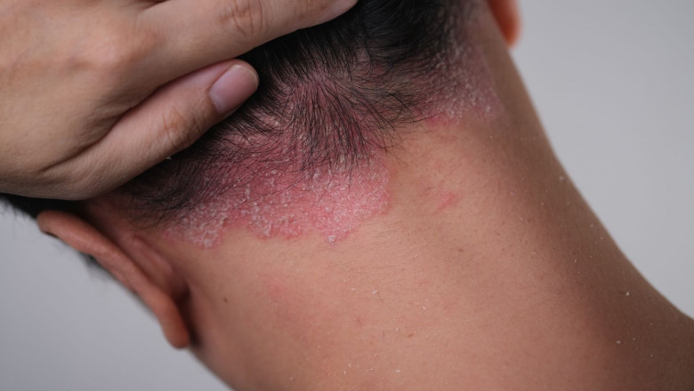 Is It Normal to Get Skin Tags?