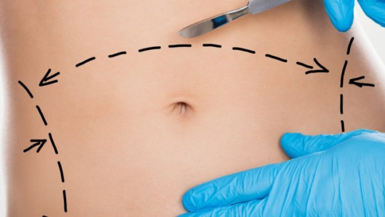 Liposuction for a Sculpted Waistline and Toned Physique