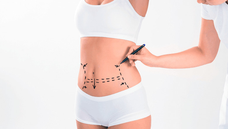 Top Liposuction Lumpy and Bumpy treatments | 2025