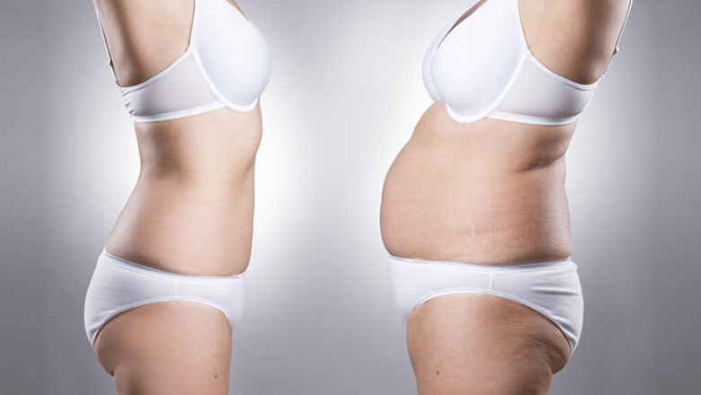 Tummy Tuck Surgery cost in Delhi - Dr Rajat Gupta