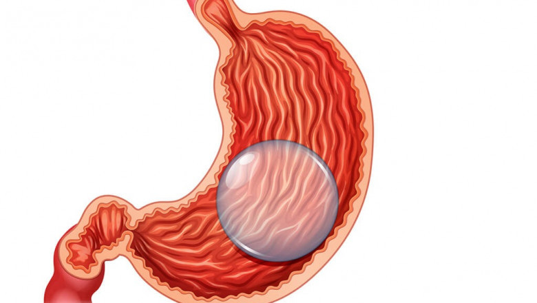 Gastric Balloon Placement and Diet
