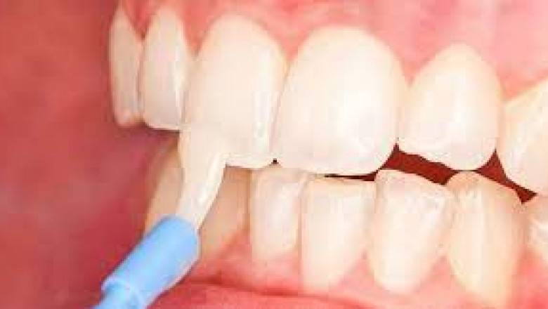 Teeth Desensitizer Market Insights Emerging Trends and Key Factors Impacting Industry Growth