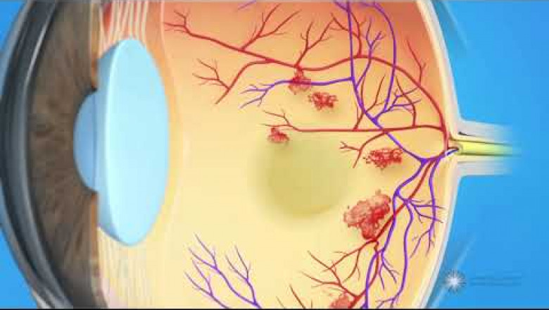 Diabetes and Blurred Vision: How Are They Connected?