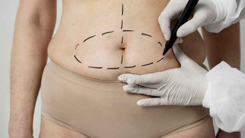 Is Tummy Tuck Safe During Menopause?