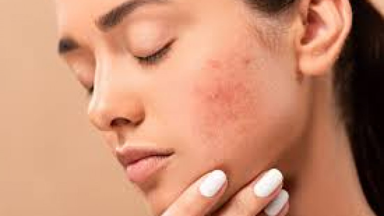 Why Glamorous Clinic is Dubai’s Choice for Acne Scar Treatment