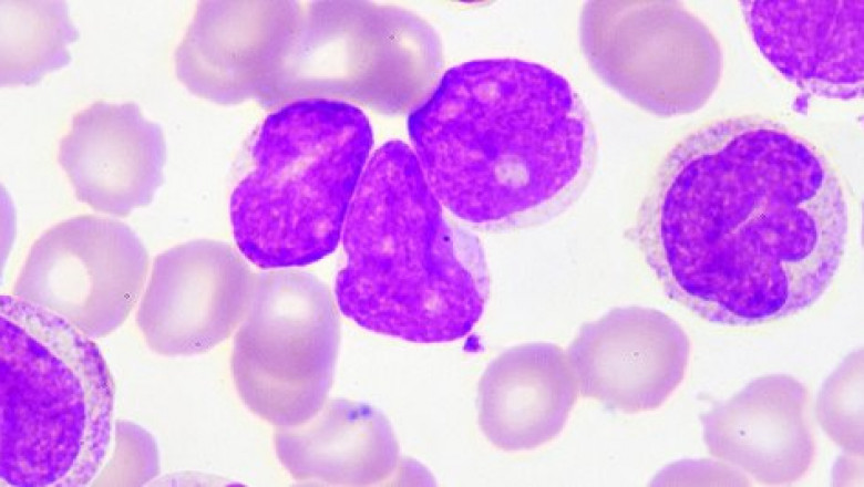 Acute Myeloid Leukemia AML Market to Surge with Immunotherapy Advances