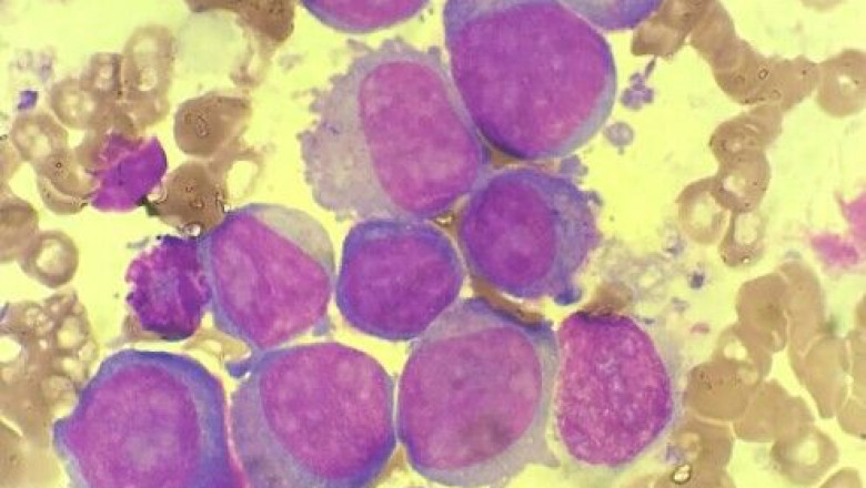 ALCL Treatment Market to Witness High Growth Owing to CAR T-cell Therapy