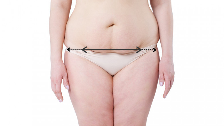 Enhancing Your Postpartum Shape with a Tummy Tuck