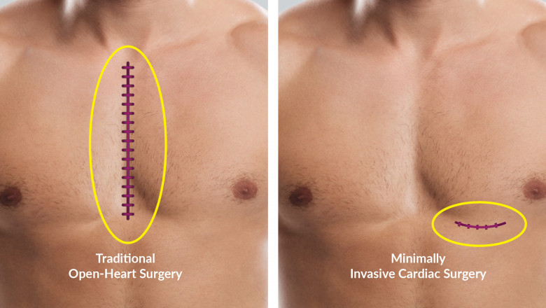 Open Heart Surgery vs. Minimally Invasive Heart Surgery: Key Differences