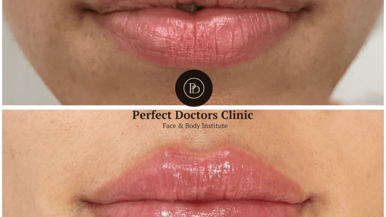 The Secret to Smooth Skin: Juvederm by the Best Doctors in dubai